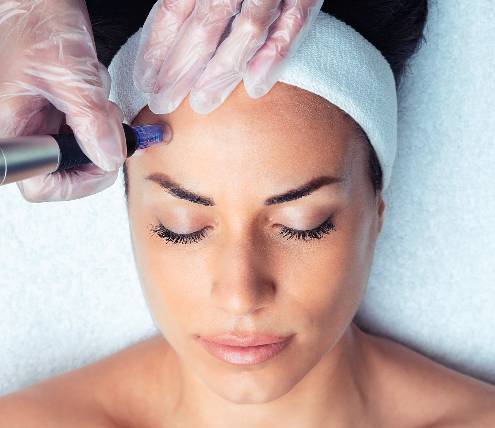 microneedling-cover-beau-corps-belle-gueule-paris